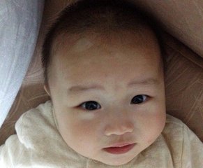 北京治疗白癜风专科医院：儿童白癜风要怎么治疗
