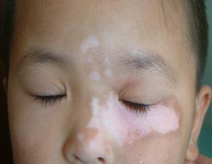 北京治疗白癜风专科医院：儿童出现白癜风的影响